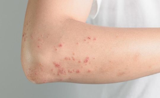 As principais doencas na pele relacionadas ao estresse sao as dermatites acne psoriase vitiligo e queda capilar Visor Notícias