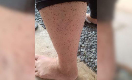 Febre do Oropouche Maruim Visor Notícias