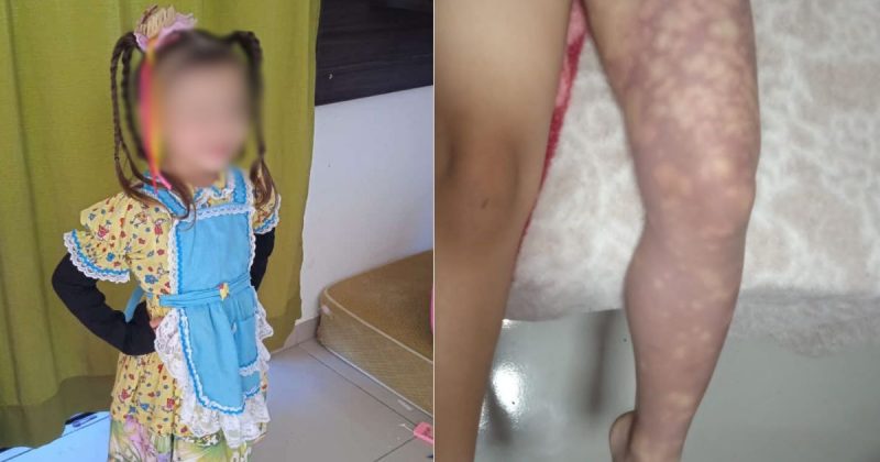 menina perna amputada 800x420 1 Visor Notícias