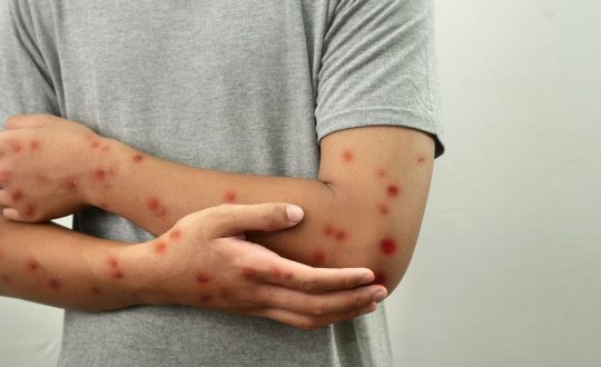 mpox caso Visor Notícias